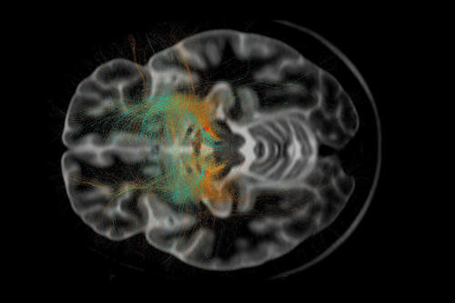 NeuroCure aims to find new perspectives in the treatment of neurological diseases.