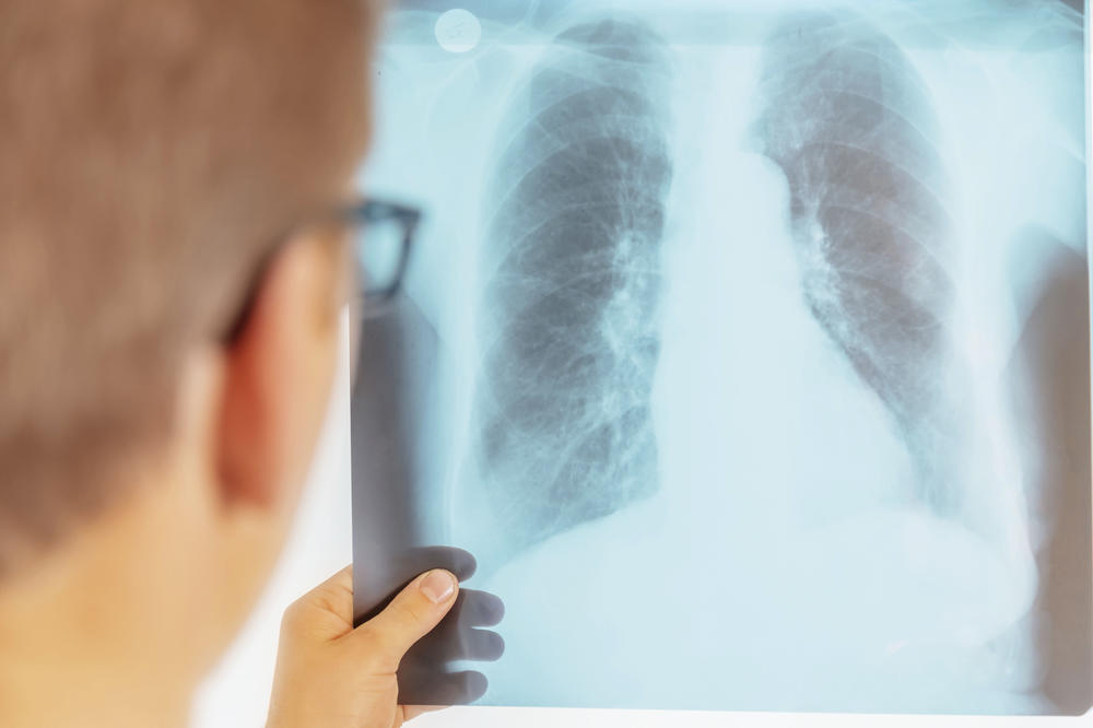 Entzündliche Verdichtungen des Gewebes sind bei bakteriellen Pneumonien auf dem Röntgenbild oft gut sichtbar. Was genau in der Lunge passiert, wenn sie von Erregern wie Pneumokokken befallen ist, ist noch nicht erforscht.