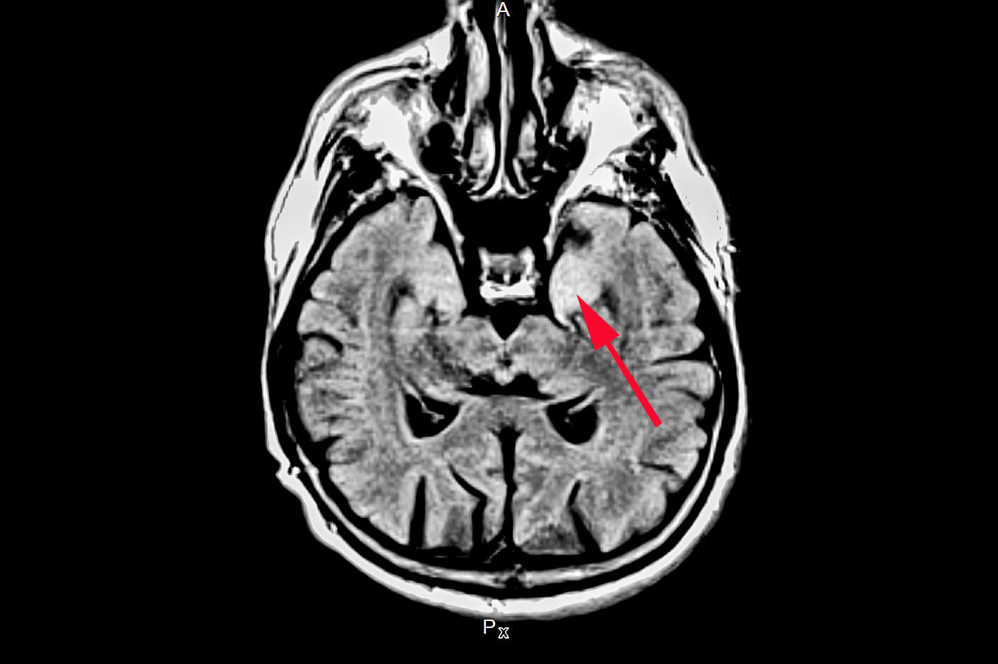 MRT-Bild eines Patienten mit einer autoimmunen Hirnentzündung. Vor allem Teile des Schläfenlappens (Pfeil) sind besonders häufig von der Entzündung betroffen.