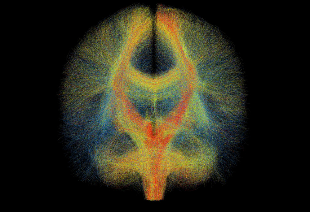 The working brain can only be observed to a limited extent. Researchers use images like these to improve Parkinson’s therapy.